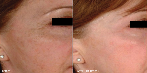 microneedle-los-angeles-before-and-after