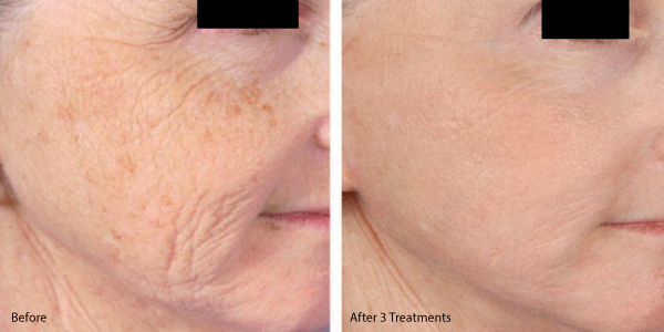 microneedling-with-prp-before-and-after