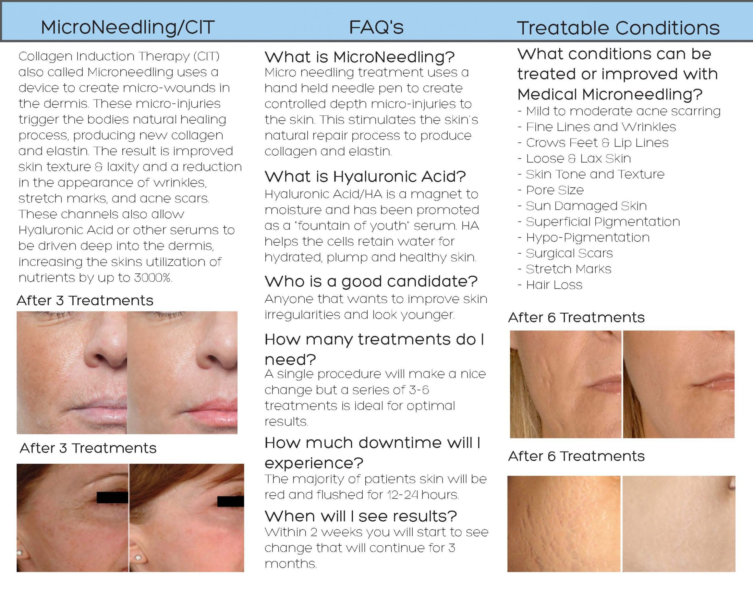 What is MicroNeedling with MD Needle Pen - Micro Needling Pen 