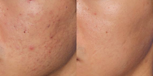 How to Find the Best Acne Scar Treatment for Your Skin