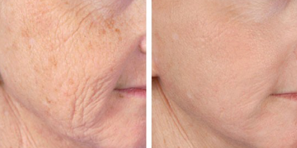 How Long After Botox Can You Get Microneedling?  