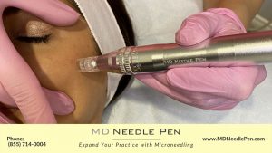 Microneedling treatment